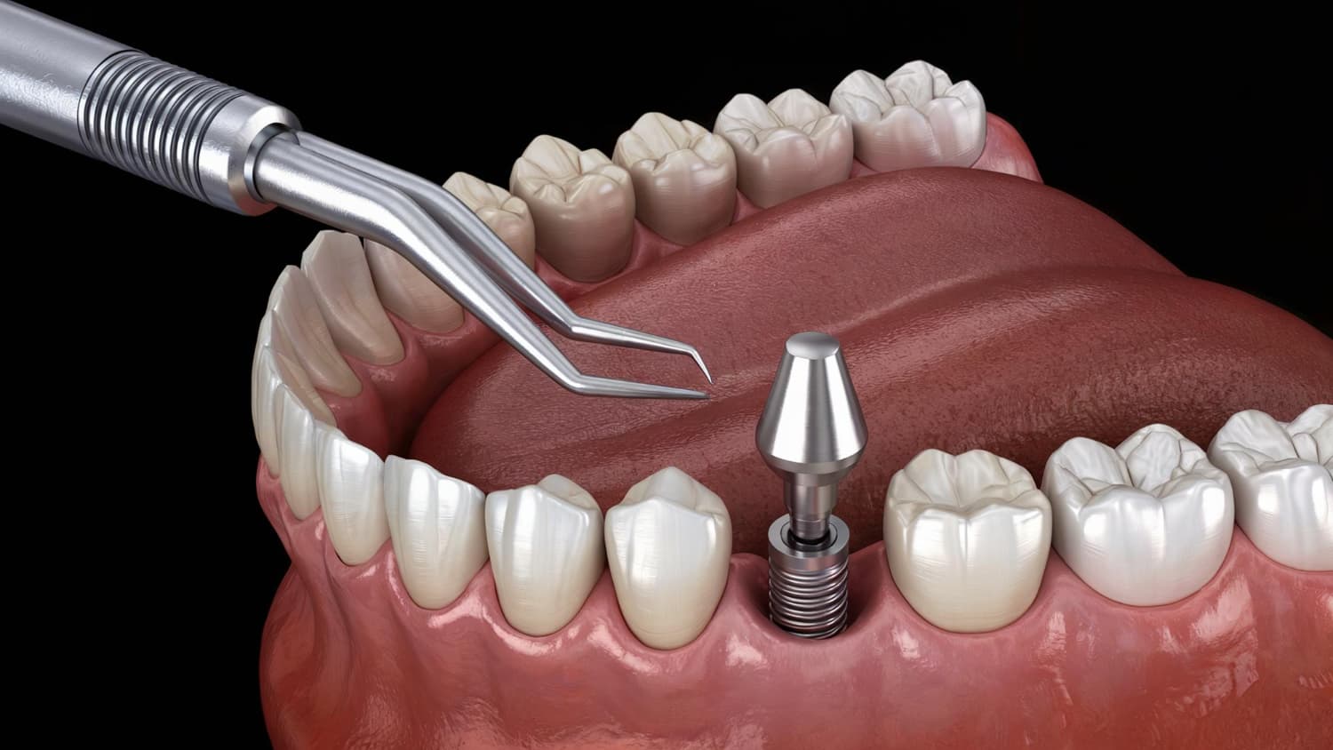 Experienced implant specialists at DDS