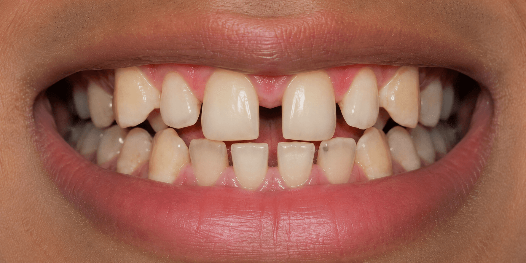 Diastema Gap Closure - Before