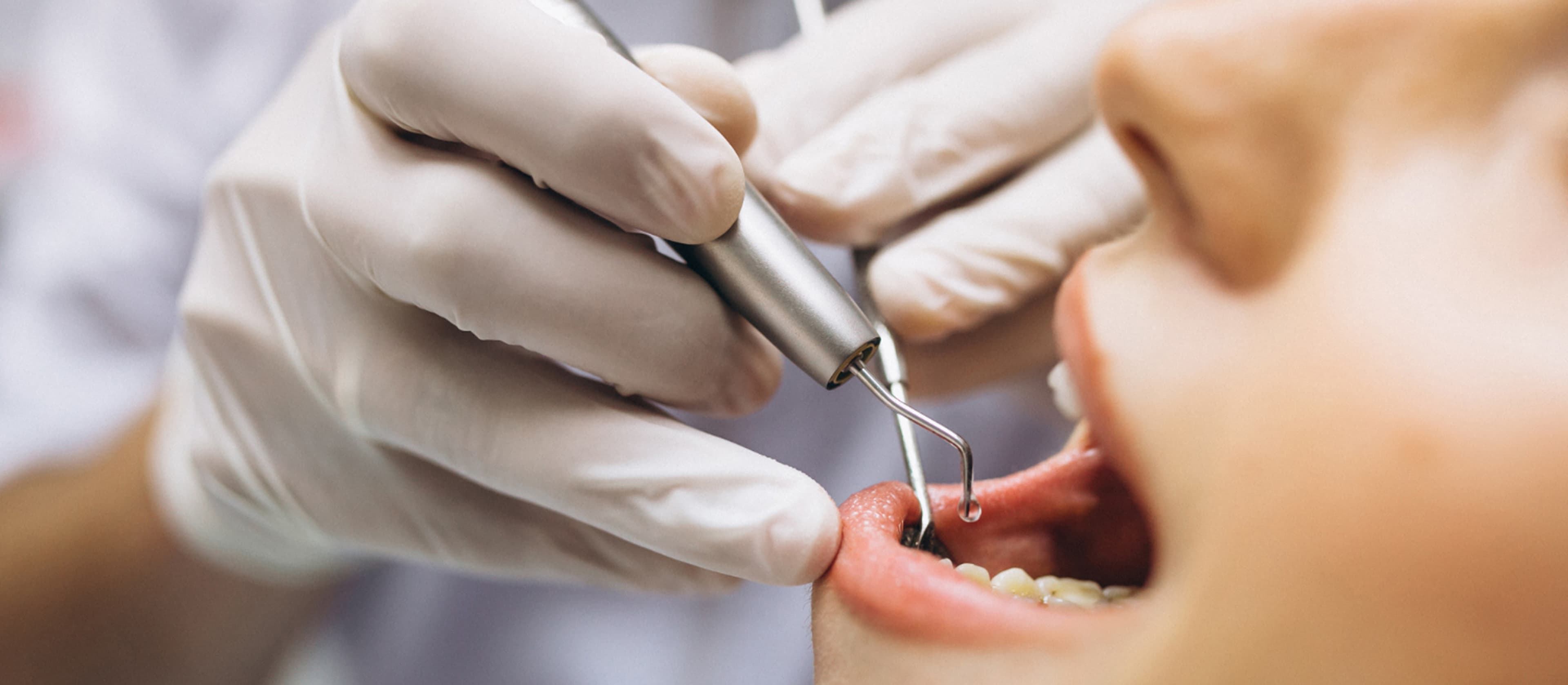 Natural endodontic treatment results at DDS