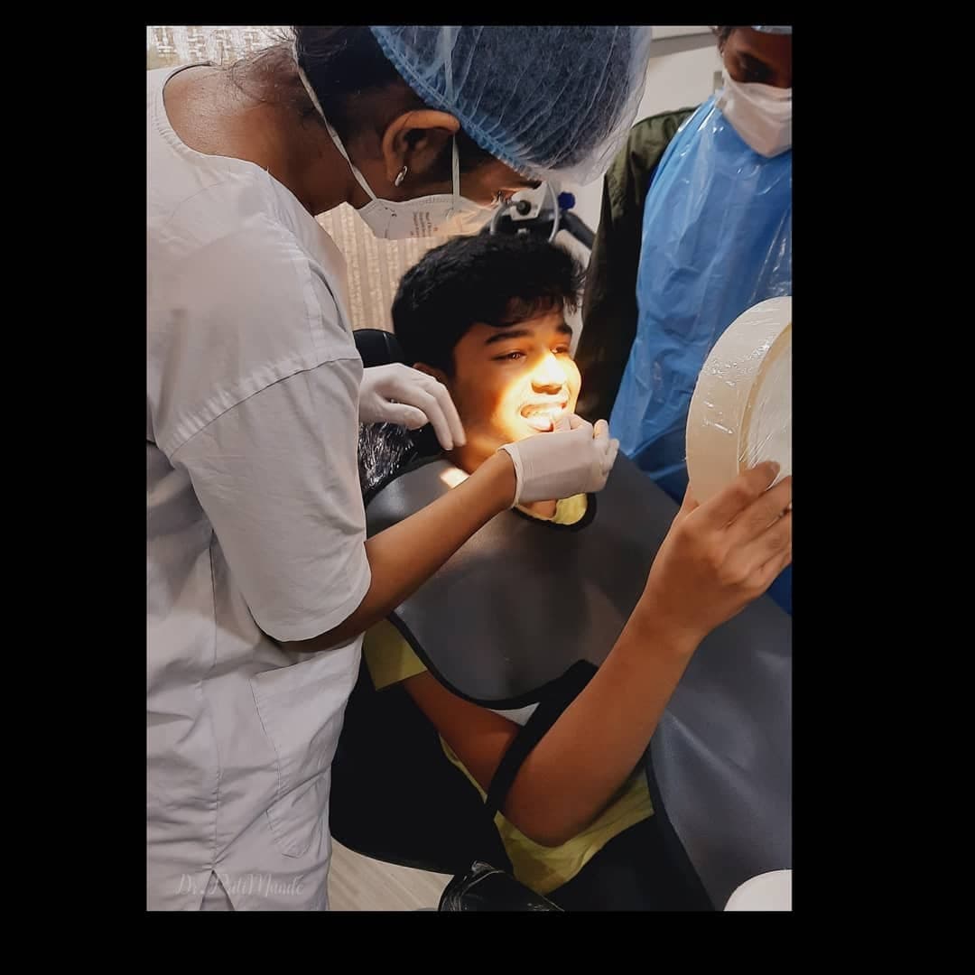 Laser Whitening Session