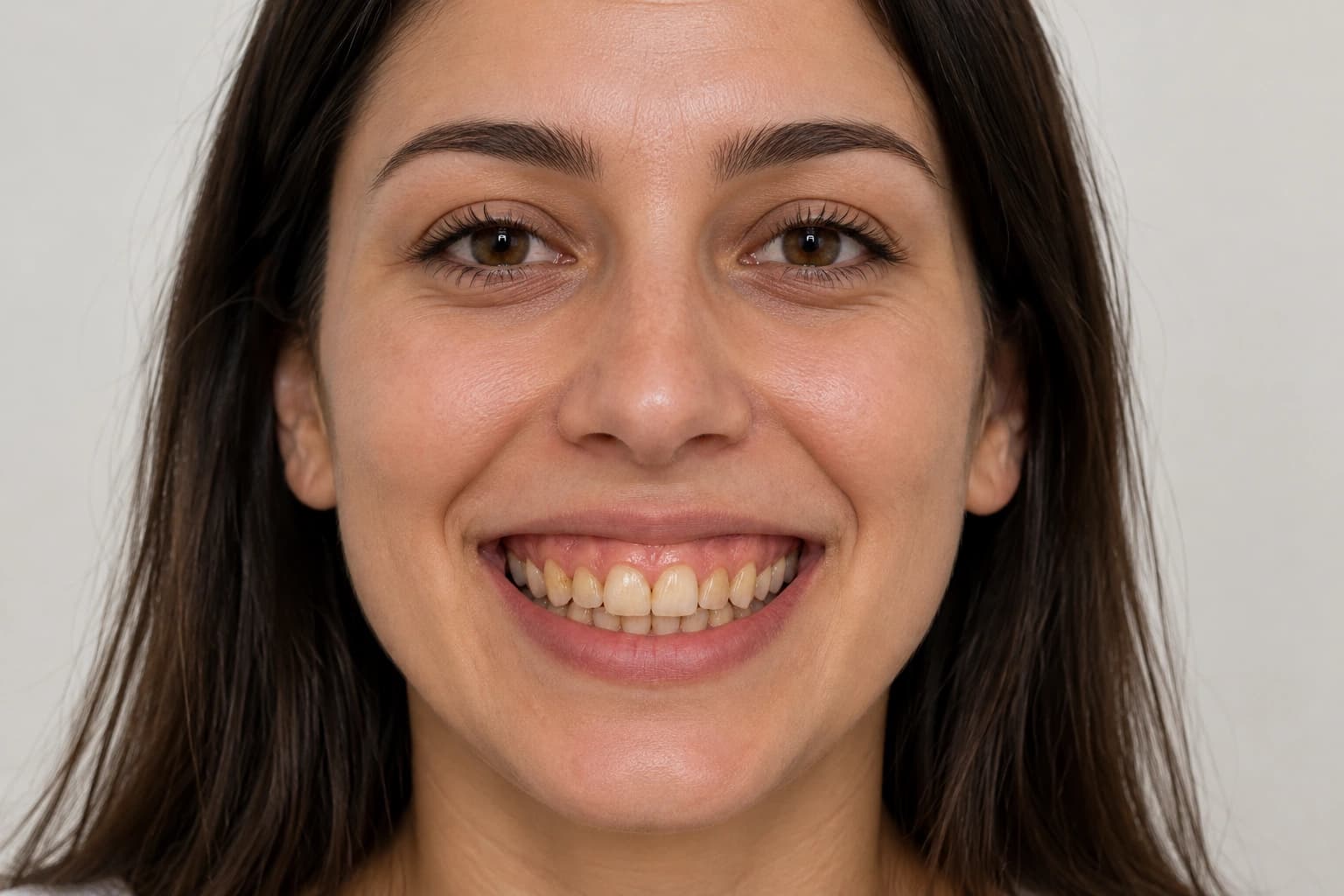Gum & Aesthetic Gum Care Smile Transformation - Before