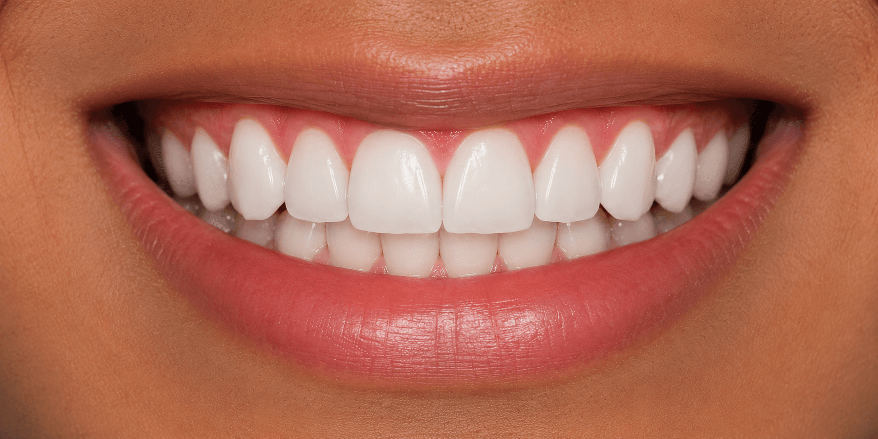 Smile Symmetry Correction - After