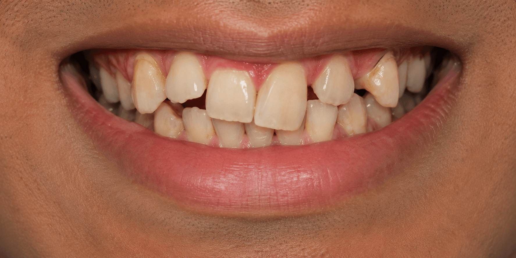 Smile Symmetry Correction - Before
